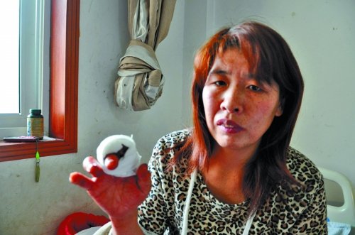 翟女士經(jīng)過(guò)首次植皮手術(shù)之后的右手