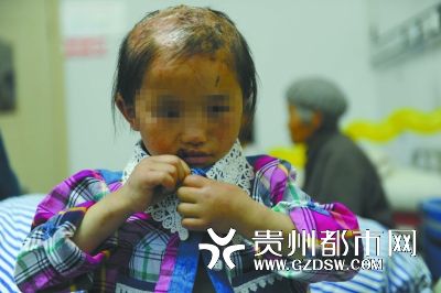 被燙傷的頭皮一直沒有愈合。