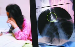 假牙上的鋼絲刺破食管，而薄薄的食道壁緊貼主動脈血管，極易造成血管破裂