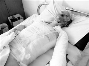 周小姐的頭、頸、軀干、四肢均被燒傷，其中面部燒傷最為嚴(yán)重。