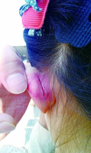 　　女童的耳朵被老師揪裂。圖片由女童家人提供