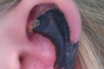 荷蘭女子旅游途中被蜘蛛咬，耳軟骨溶解變黑。