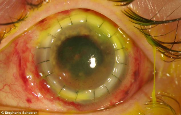 恐怖慎入！隱形眼鏡致英女子摘除眼球