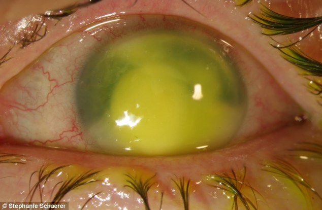 恐怖慎入！隱形眼鏡致英女子摘除眼球