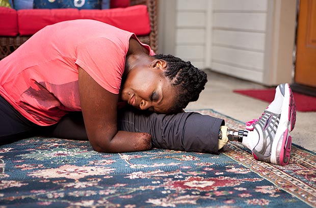 愛美媽媽整形導致截肢