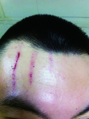 　2013年，被打者受傷照