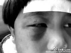 6月2日，網(wǎng)曝渭南市臨渭區(qū)一不滿5歲的女童遭奶奶毆打，眼圈青腫，引起網(wǎng)友關注，但孩子父母和爺爺均稱是摔倒導致。相關部門介入調(diào)查發(fā)現(xiàn)確為奶奶毆打所致，鑒于其身體原因已進行批評教育。