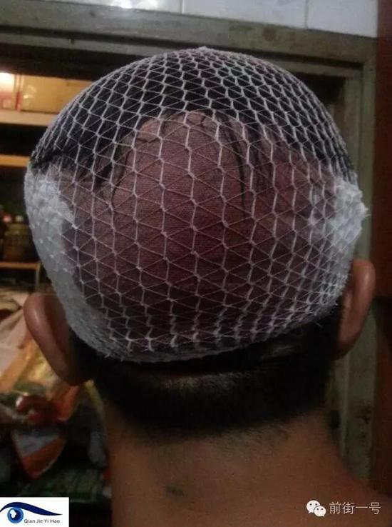 李律師受傷后縫合三針。