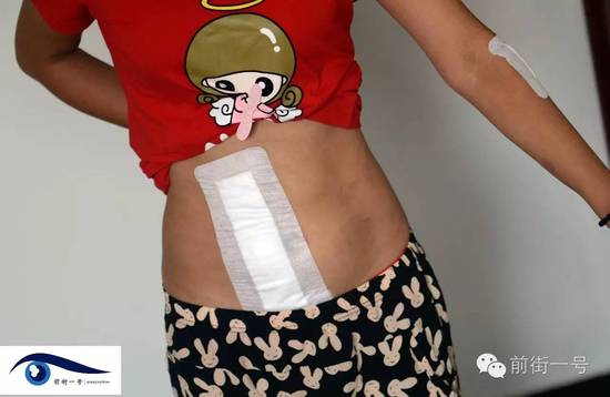 小金腹部的傷口。