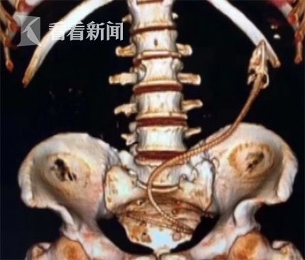 黃鱔從肛門鉆進(jìn)肚子 男子被送醫(yī)不愿多談事情經(jīng)過