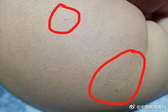 據多名紅黃藍(新天地分園)家長反映，孩子腿部、屁股、腋下出現針眼。