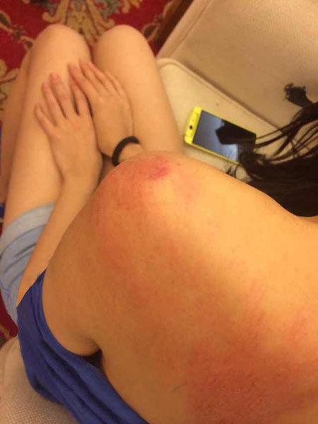 “跑男”真的很拼！baby朋友圈曬后背紅腫照