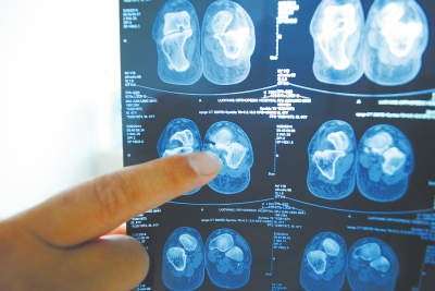 X光片顯示,確實有一根殘留的螺絲釘。