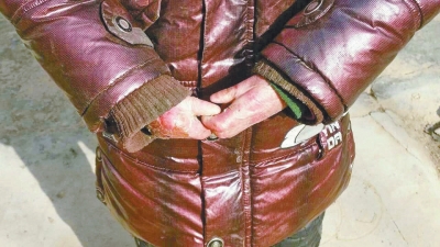 長(zhǎng)期受損的手指，已經(jīng)長(zhǎng)在了一起。