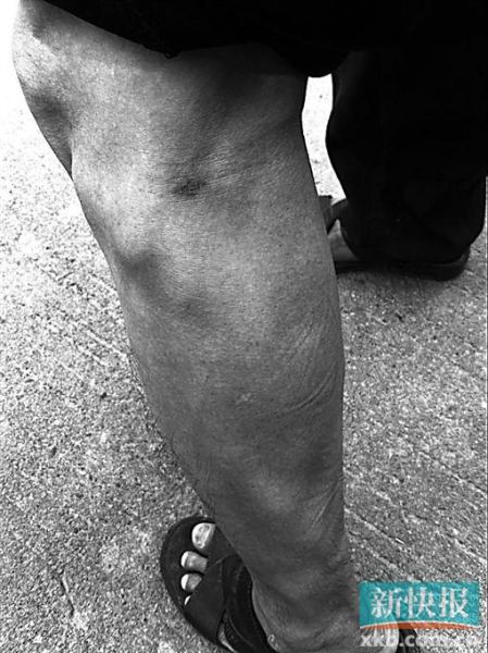 傷者身上遺留的彈痕。