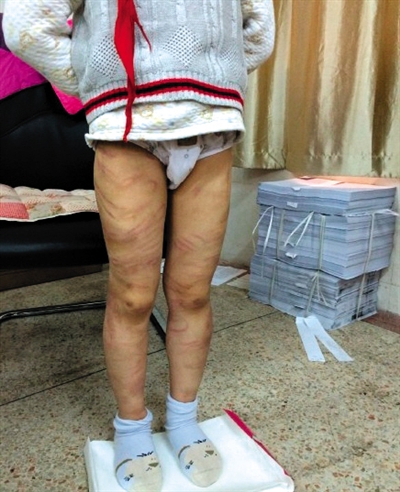 4月3日晚，微博網(wǎng)友“@朝廷半日閑”發(fā)圖文微博展示男童被虐待的慘狀。 微博截圖