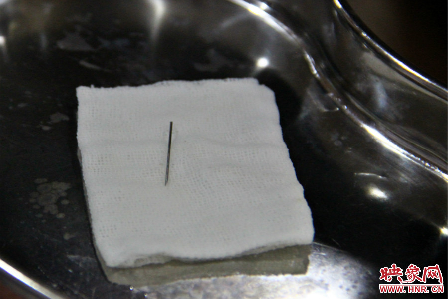 上午11點(diǎn)30分許，小龍腦中鋼針已經(jīng)成功取出。