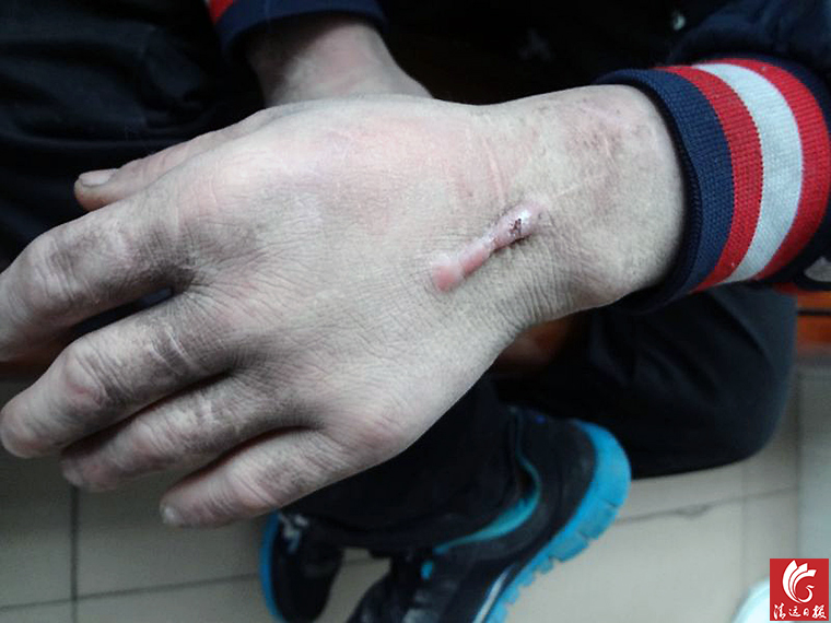 被發(fā)現(xiàn)男子手上的傷疤。