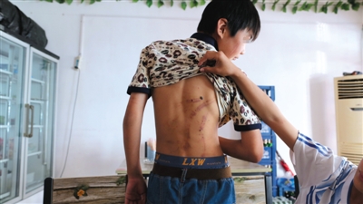 　昨日，奶西村，被打的小剛后背上條條瘀痕依然明顯。