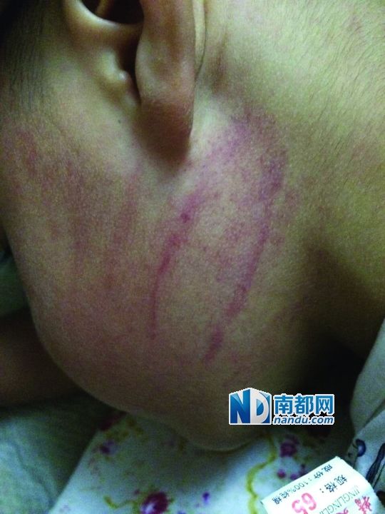 小逸臉上淤痕清晰可見。