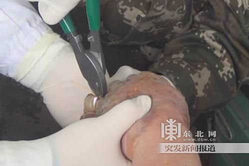 正在拆除戒指。