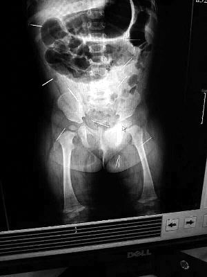 目前體內(nèi)的12根鋼針多分布在孩子的臀部，一根在腹部，其余3根在胸腔附近，其中一根很接近心臟