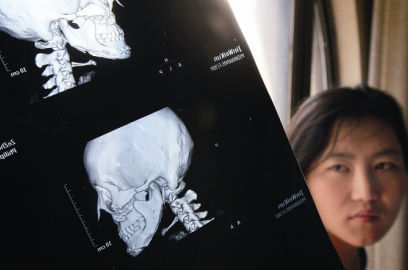 國內(nèi)醫(yī)院CT顯示，如今靳魏坤的鼻子假體是歪的，連下巴也是歪的