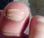 一幼兒園兒童“指甲異?！? title=